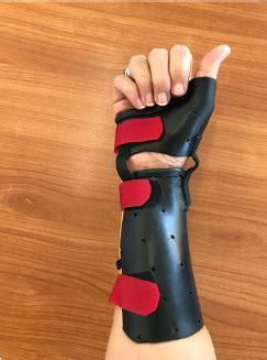 A new splint design for De Quervains Tenosynovitis - GC Hand Therapy