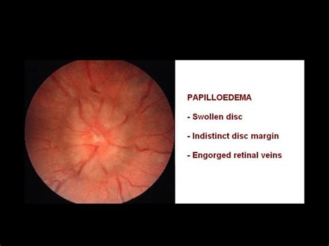 Optic nerve Diseases By: Sumayya Naseem Optometrist