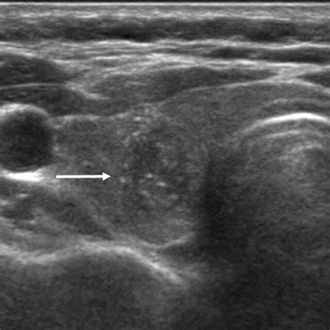 Symptomatic Anaplastic Thyroid Carcinoma In A 58 Year Old Woman With