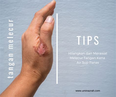 Tips Hilangkan Dan Merawat Melecur Tangan Kena Air Sup Panas Umi Nazrah