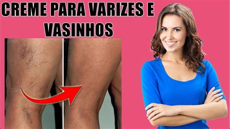 Como Amenizar As Varizes E Os Vasinhos Creme Varyforte Funciona