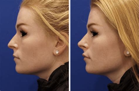 Liquid Rhinoplasty Mao Facial Plastics