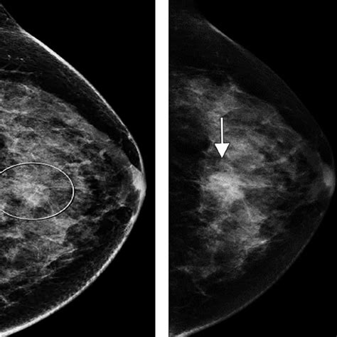 Contrast Enhanced Mammography Current Applications And Future