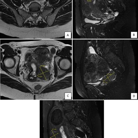 Obstructive Cervical Fibroid Prolapsing Through Into Vagina Download