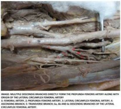 Multiple descending branches directly from the profunda femoris artery... | Download Scientific ...