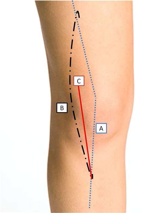 Swashbuckler Approach For Distal Femur Fractures A Systematic Review