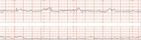 Fetal Heart Rate Assessment Flashcards Quizlet