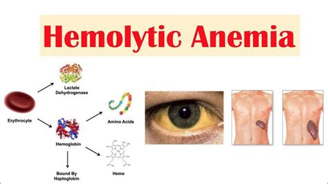 Hemolytic Anemia MEDizzy