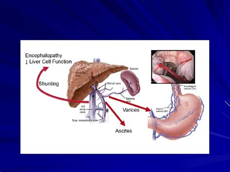 Pathophysiology of ascites in cirrhosis Khalid Alswat MD