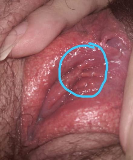 Me Salieron Unos Granos En La Vagina