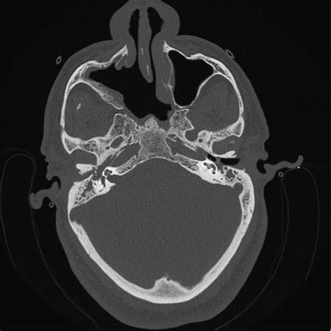 Non Contrasted Computed Tomography Showing Soft Tissue Densities In The