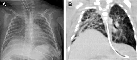 Respiratory Distress In Neonates Radiologic Clinics