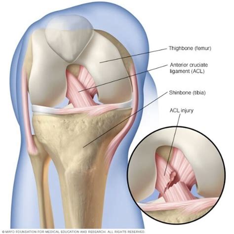 Acl Rehabilitation Protocol What To Do After Surgery