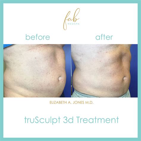 Trusculpt D Body Sculpting Fab Med Spa