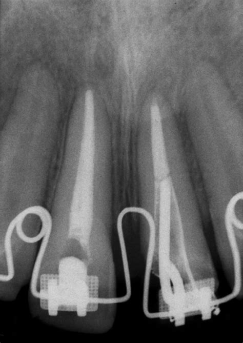 Definitive Root Canal Treatment With The Temporary Intracanal Post