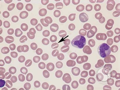 Stomatocytosis Ask Hematologist Understand Hematology