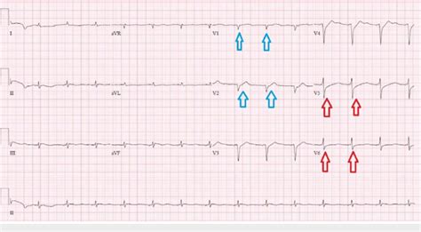 Ecg Demonstrating A Sinus Rhythm At Bpm With Nonspecific St Changes