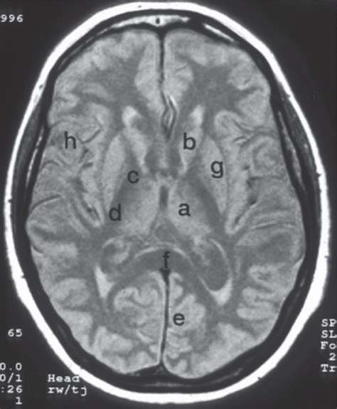 Brain MRI | Mri, Visual cortex, Corpus callosum