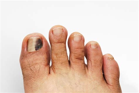 Black Spot Under Toenail Melanoma - Nail Ftempo