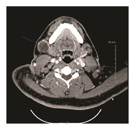 Computed Tomography Ct Scan Of Soft Tissue Neck Demonstrating Right Download Scientific