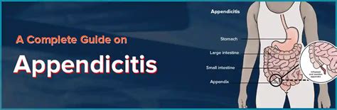 Complete Guide On Appendicitis Ganesh Diagnostic