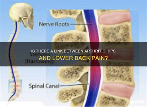 Is There A Link Between Arthritic Hips And Lower Back Pain? | MedShun