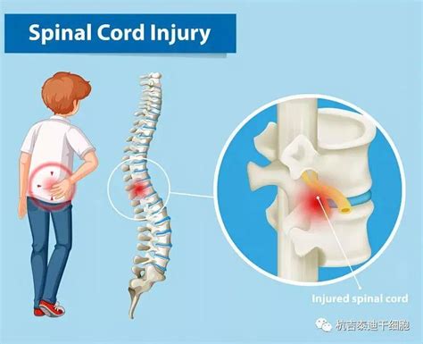干细胞治疗脊髓损伤的作用机制及研究进展 知乎