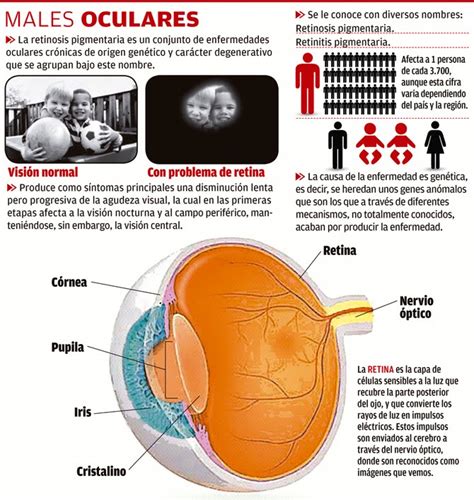 Clasificaci N Gen Tica De La Retinosis Pigmentaria Por Una Visi N