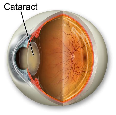 After Cataract Surgery Do S And Don Ts Eye Specialist Institute