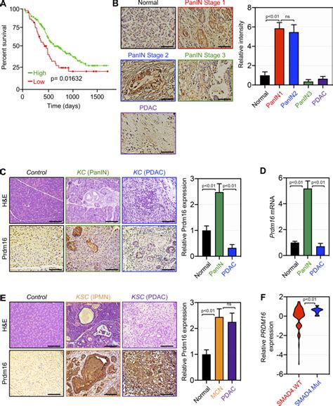 Transient Expression Of Prdm16 During Pdac Progression A