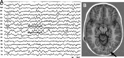 Case 9 A Interictal EEG A1A2 Reference Depicting Localized Slow