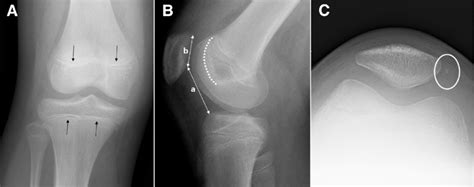 Right Knee Radiographs Including A Anteroposterior B Lateral And Download Scientific