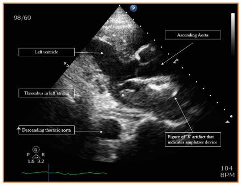 Parasternal long axis view of the transthoracic echocardiography which ...