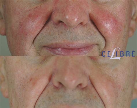 Vbeam Laser Treatment For Rosacea The Best Picture Of Beam