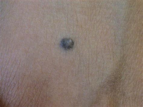 Benign Skin Lesions Nevi Cysts Blue Naevus Picture Hellenic