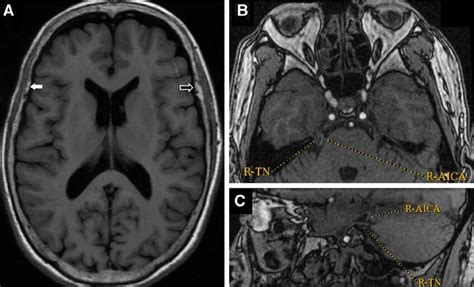 Temporalis muscle atrophy in a patient with right-sided TN. (A ...