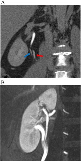 3 0tesla Magnetic Resonance Angiography Mra For Comprehensive Renal