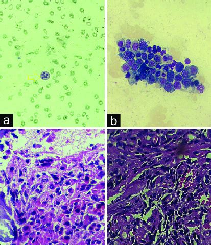 Peripheral Smear Showing Macrocytic Red Blood Cells And Hypersegmented