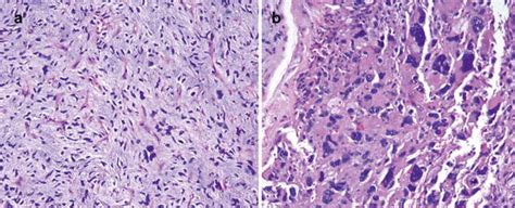 Undifferentiated Pleomorphic Sarcoma Ups Malignant Fibrous