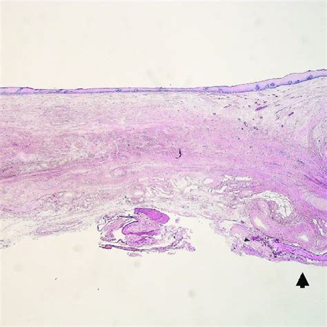 Histological Findings Of The Resected Specimen Histological Examination