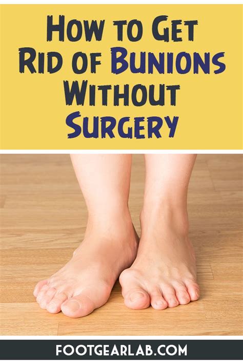 How To Get Rid Of Bunions Without Surgery In 12 Easy Ways Bunion