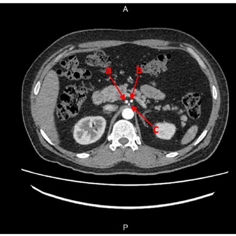 Abdominal Ct Scan Contrast In Arterial Phase Demonstrating The Common Download Scientific