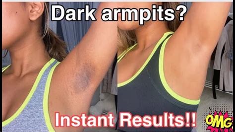 How To Get Rid Of Dark Armpits Instantly Works Youtube