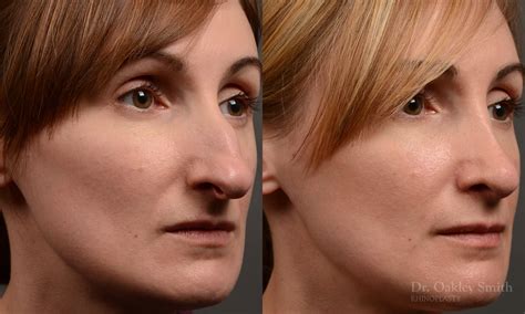 412b Rhinoplasty Dr Oakley Smith Toronto Top Surgeon Nose Job