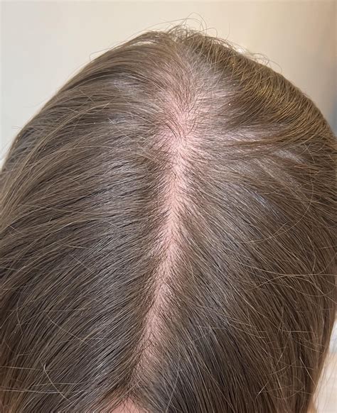 Iron Deficiency hair loss : r/FemaleHairLoss