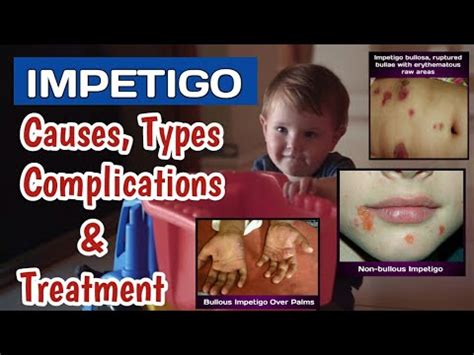 Impetigo Skin Infection Causes Types Symptoms Treatment