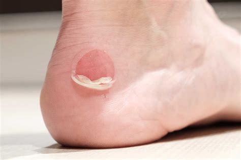 Blisters Care For Feet Tips From Shuman Podiatry And Sports Medicine