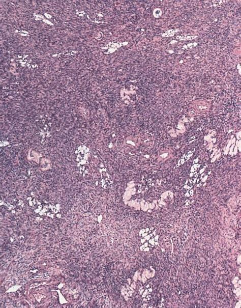 Pathology Outlines Stromal Hyperplasia And Hyperthecosis