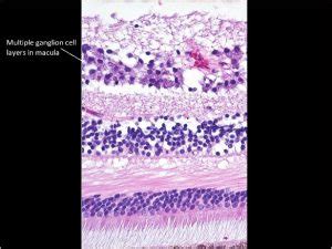 Cystoid Macular Edema Histology