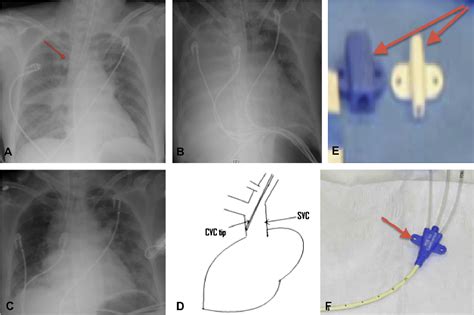 Figure From Right Internal Jugular Venous Cannulation Complicated By